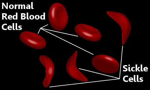 sickle cells vs normal red blood cells