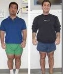 Leg-lengthening Surgery for People with Dwarfism
