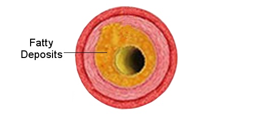 blood vessel angina