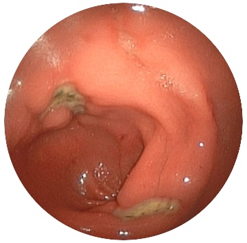 Gastric ulcers